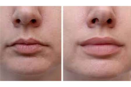 Affordable Lip Augmentation Cost in India 