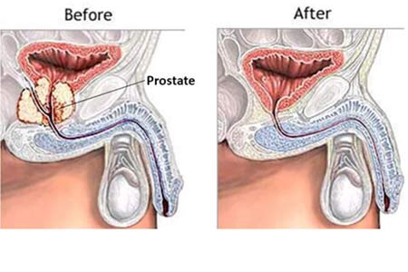 Radical Prostatectomy in India