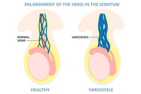 Cost of Varicocelectomy in India