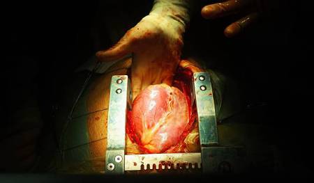 Open Heart Surgery Cost