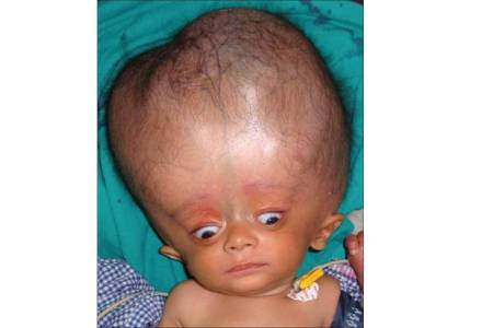 Affordable Hydrocephalus Surgery Cost