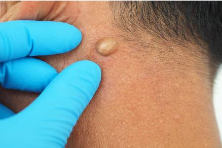 Sebaceous Cyst Removal Surgery Causes