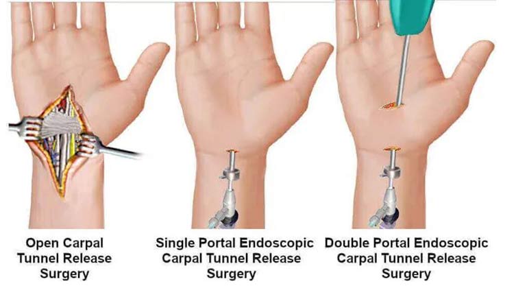 Carpal Tunnel Release Surgery in India