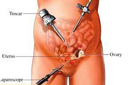 hysterectomy surgery types