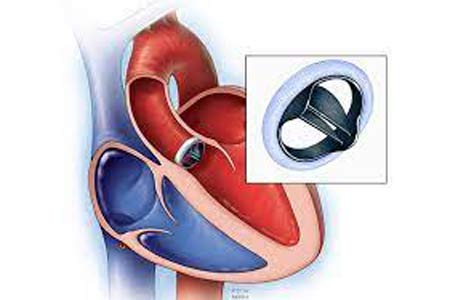 heart valve replacement side effects