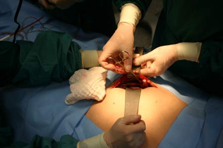 Appendicitis Surgery in India