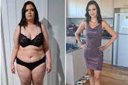 Weight loss Surgery in India