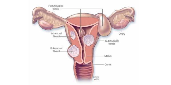 Affordable  treatment of fibroids surgery in India