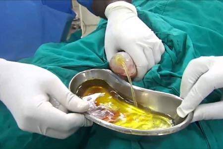 Hydrocele Surgery in India
