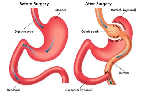 Gastric Banding Surgery side effects