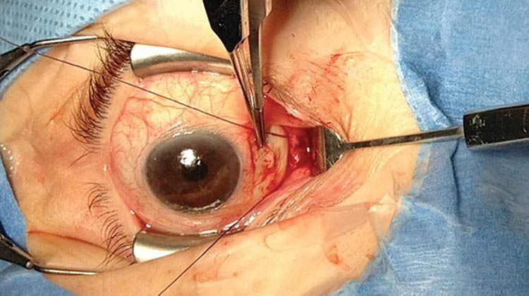 Strabismus Surgery in India