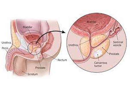 prostate cancer treatment types
