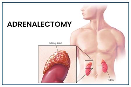 Adrenalectomy Surgery in India