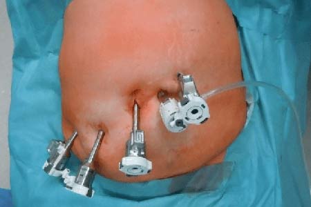 Gallbladder Removal Surgery Types