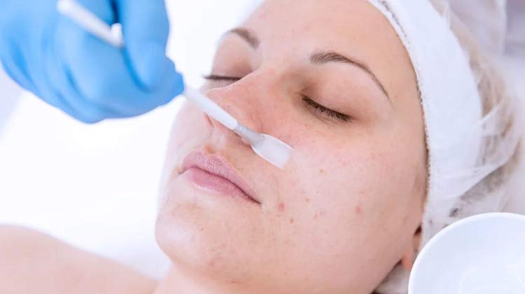 Chemical Peeling Treatment in India