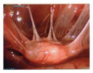 pelvic adhesiolysis surgery side effects