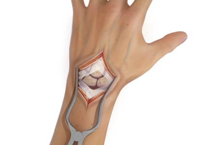 Wrist Instability Treatment Diagnosis