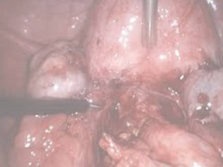 Uterosacral nerve ablation surgery before and after