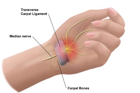 carpal tunnel release surgery side effects