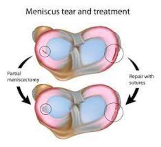 Meniscectomy Surgery side effects