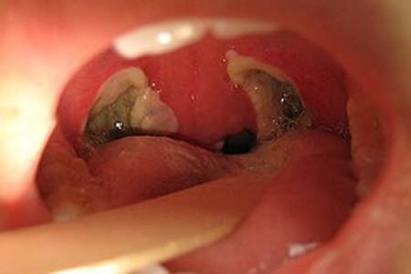 tonsillectomy surgery types