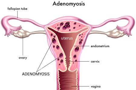 Focal Adenomyosis Types