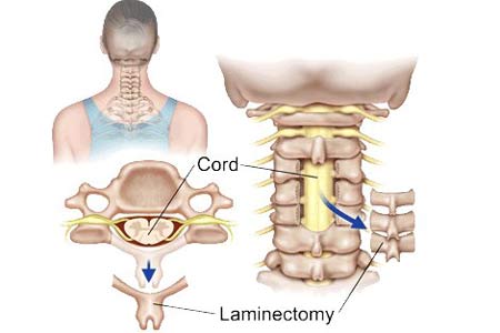Laminotomy Surgery in India