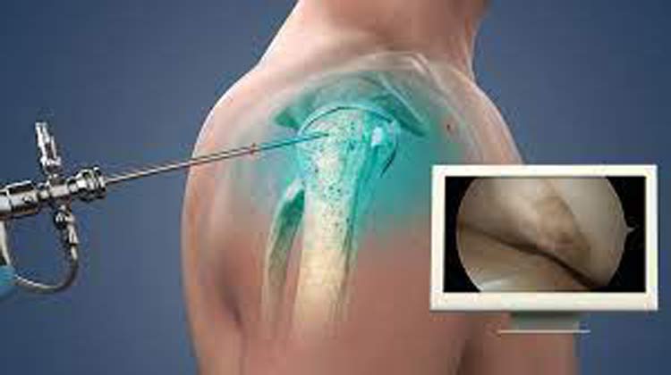 Shoulder Surgery in India