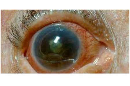 Affordable Glaucoma Treatment Cost in India