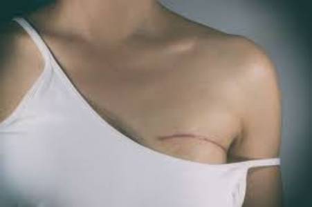 Breast Tumor Removal Surgery in India