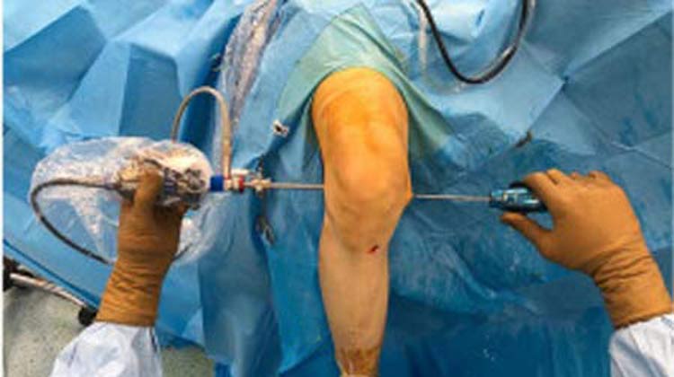 Knee Arthroscopy in India