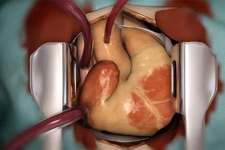 heart transplant types