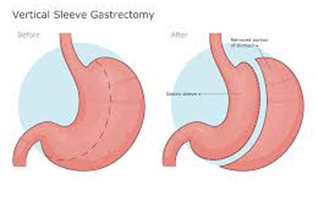 sleeve gastrectomy surgery before and after