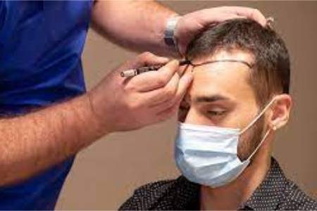 Low Cost of Hair Transplant surgery