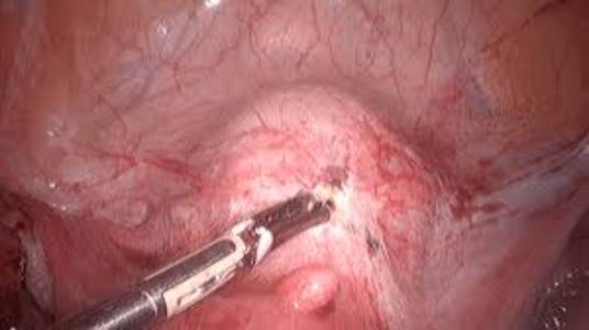 Uterosacral nerve ablation surgery types